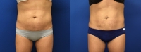 Before & After ThermiTight Abdomen