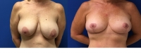 Before and After Breast Lift