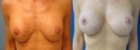 Before and After Breast Lift