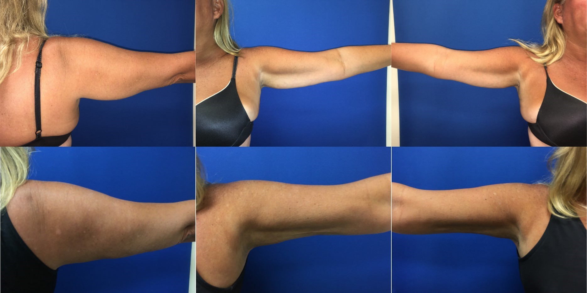 Before & After Smartlipo Arms