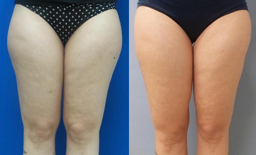 Before & After Smartlipo Thighs and Knees