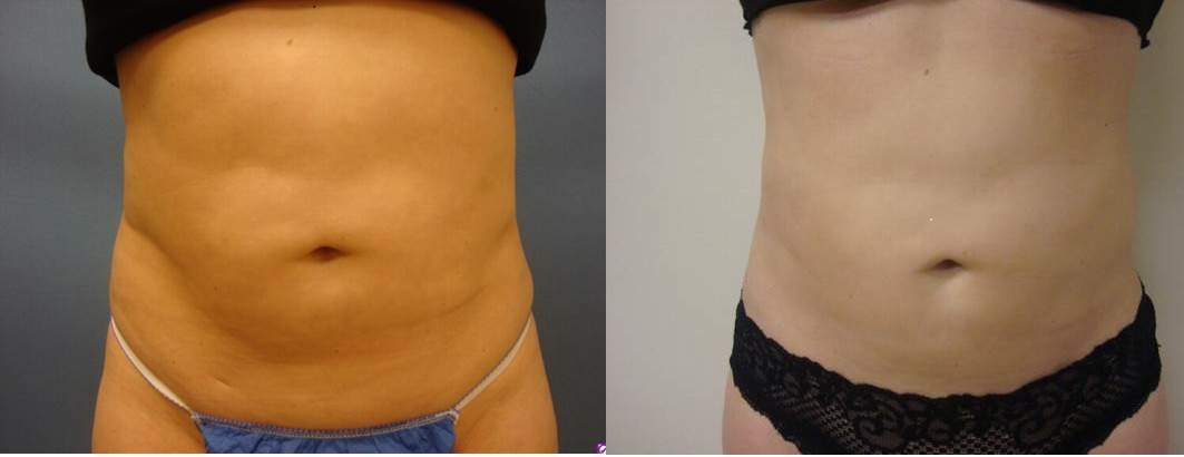 Before & After SmartLipo