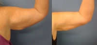 Before & after Arm Smartlipo