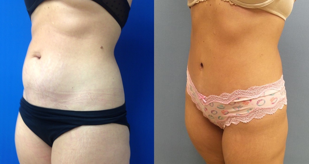 Before & After Liposuction and mole removal