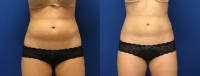 Before & After Abdomen  CoolSculpting