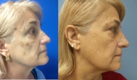 Before and After Photofacial
