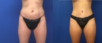 Before & After Abdominoplasty