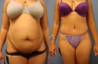 Before & After Abdominoplasty