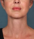 Kybella After Age 39 Front