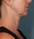 Kybella Before Age 39 Side