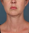 Kybella Before Age 39 front