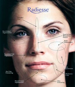 Radiesse Model Face
