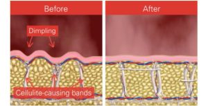 Diagram of fat reduction