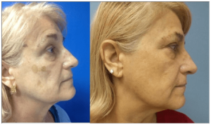 Dr. Thompson - Photofacial patient before and after photos 