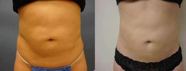 Liposuction Before and After photos by Dr. Thompson