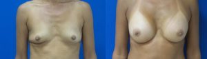 Thompson Before-and-After-Breast-Aug-7354