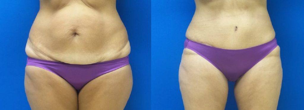 Before-and-after-tummytuck Thompson