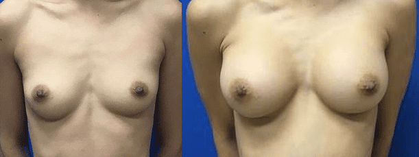 Breast Implant Breast Implant Patient Thompson