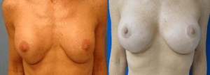 Thompson Breast Lift Patient with Breast Aug