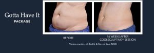 Coolsculpting results tummy