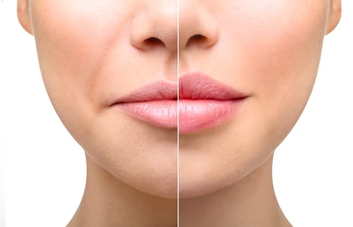 Rendering of Before and After Lip Augmentation