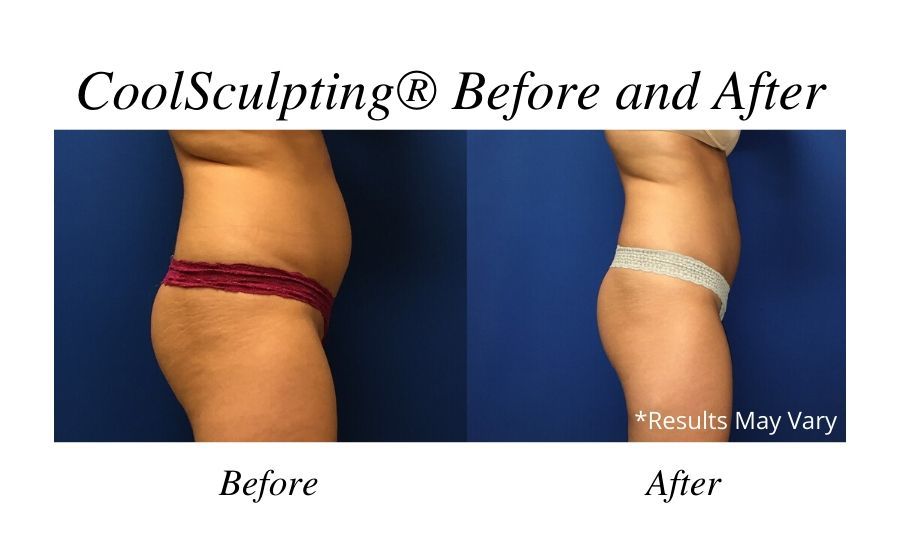 Before and after image showing the results of CoolSculpting® performed by Dr. Rudolf Thompson in Colts Neck, NJ.